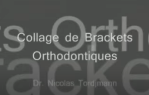Collage de brackets orthodontiques